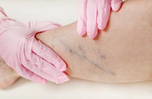 Varicose veins on the womans legs close up